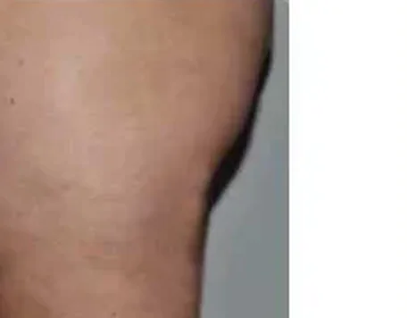 Body Contouring — after