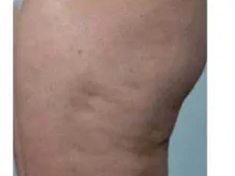 Body Contouring — before