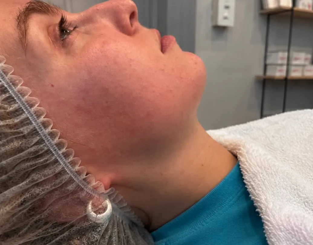 Facial Contouring — after