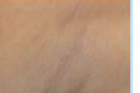 Laser Hair Removal — after