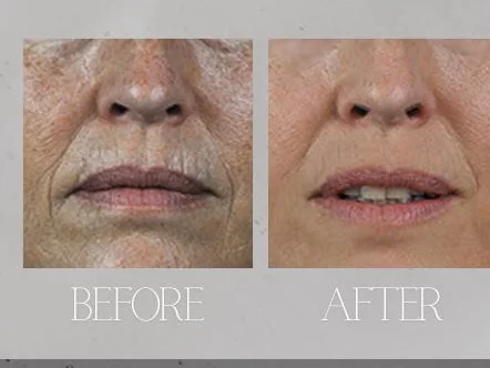 Skin Rejuvenation — before and after