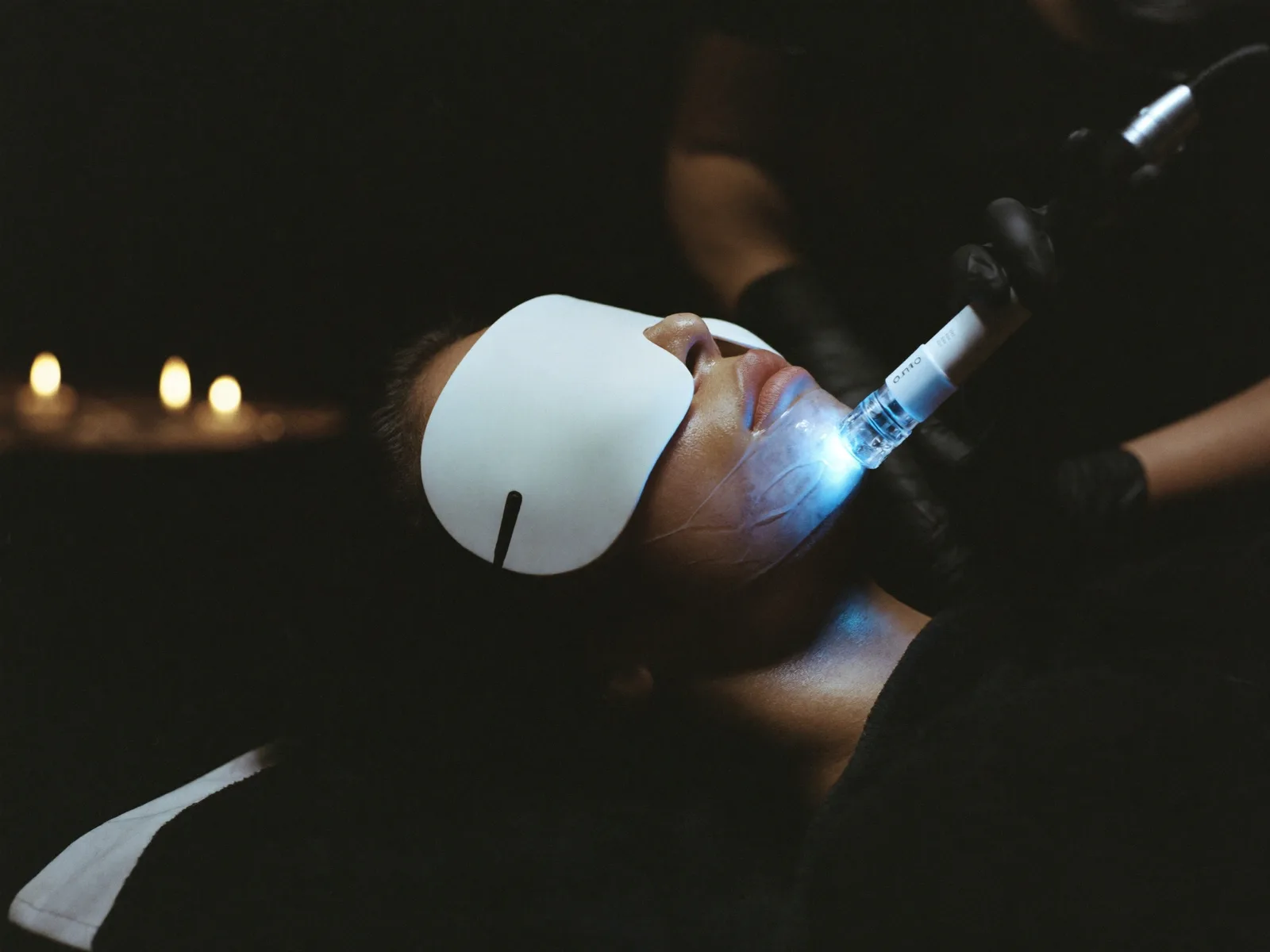 IPL Photofacials for Sun Damage: A London Guide